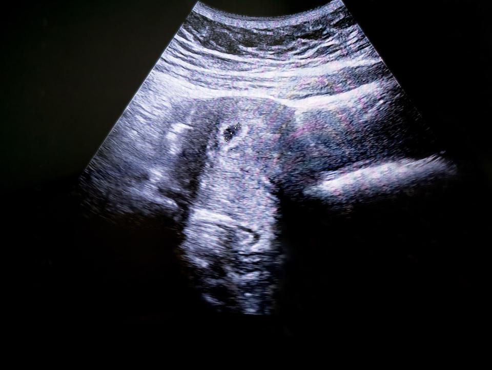 Ultraschallbild vom Unterleib in der fünften Woche Schwangerschaft